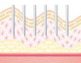 超極細針で微細な穴を皮膚に開けます。