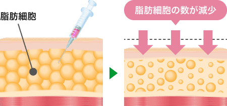 脂肪溶解スリム注射とは？