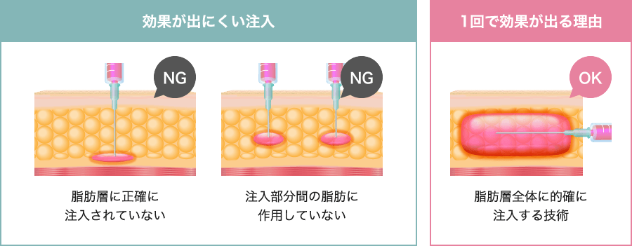 1度で効果を出すための注入技術