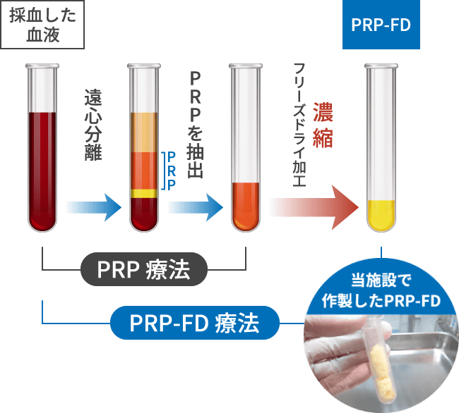 PRP-FD療法とPRP療法の違い