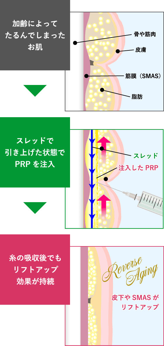 長期間リフトアップ＆美肌波及効果