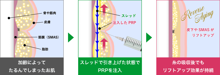 長期間リフトアップ＆美肌波及効果