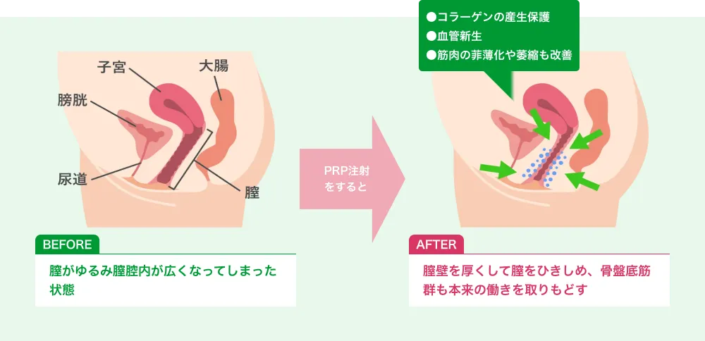 膣壁を厚くして膣をひきしめ、骨盤底筋群も本来の働きを取りもどす