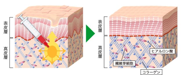 ご自分の肌が再生するから効果が長期に持続