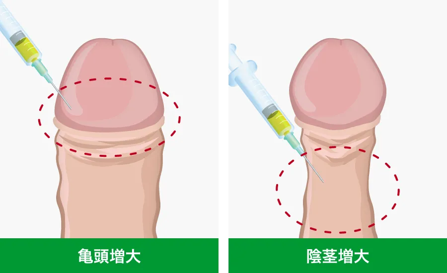 亀頭増大・陰茎増大