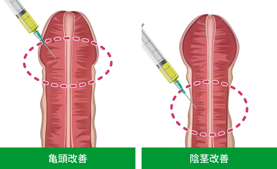 亀頭改善・陰茎改善