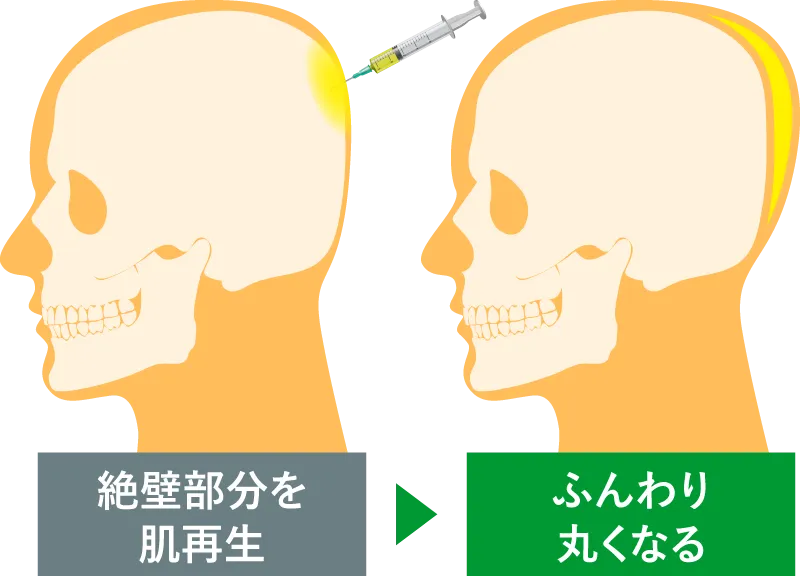 PRPG注入治療による後頭部形成術とは、多血小板血漿（PRP）に、成長因子であるFGFを添加し、頭皮に注入することで、後頭部に自然なボリューム感を出し、美しい頭の形にする治療です。後頭部が平らでボリュームがないこと（絶壁）が悩みの方を対象に、切開なしで希望の形にすることができます。施術後も異物感が無くて痛みがないので施術当日から日常生活が可能です。