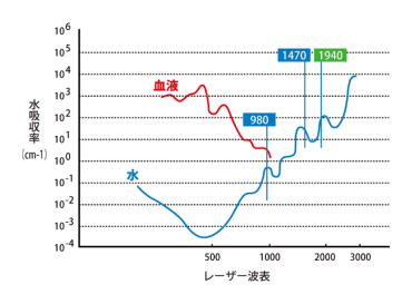 レーザー治療