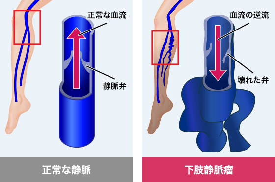 下肢静脈瘤とは