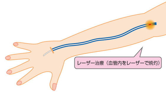 レーザー治療(血管内をレーザーで焼灼)