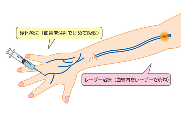硬化療法とレーザー治療の同時施行