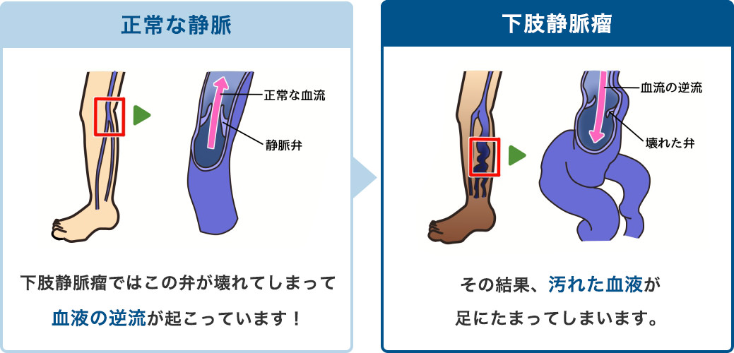 静脈の逆流防止弁が壊れると汚れた血液が足に溜まってしまいます。