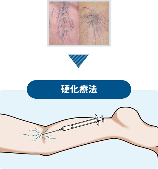 細かい血管に対する硬化療法