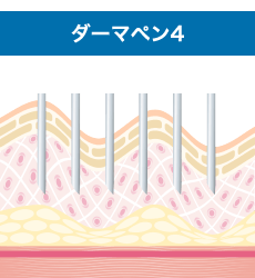 超極細針で微細な穴を皮膚に開けます。