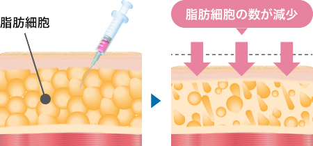 脂肪溶解スリム注射とは？