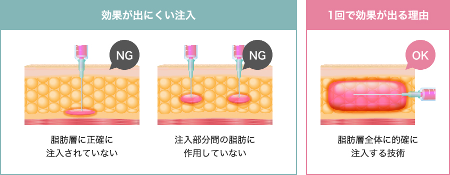 1度で効果を出すための注入技術