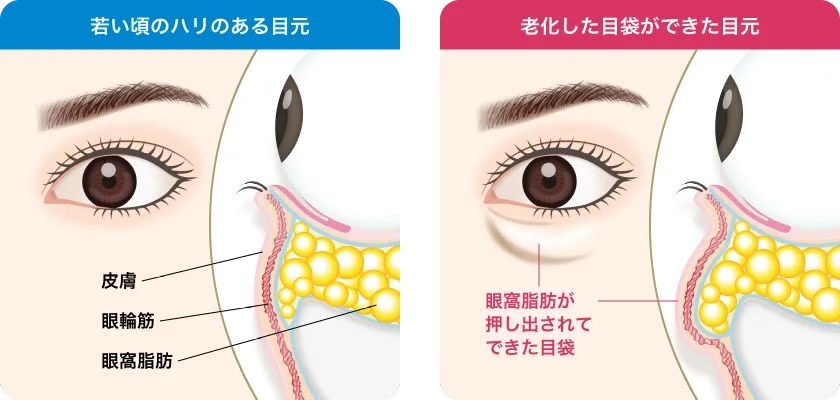 PRP下眼瞼脱脂術