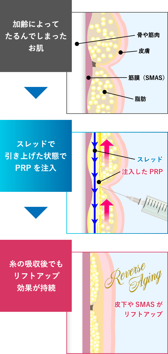 長期間リフトアップ＆美肌波及効果