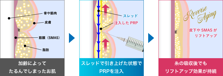 長期間リフトアップ＆美肌波及効果