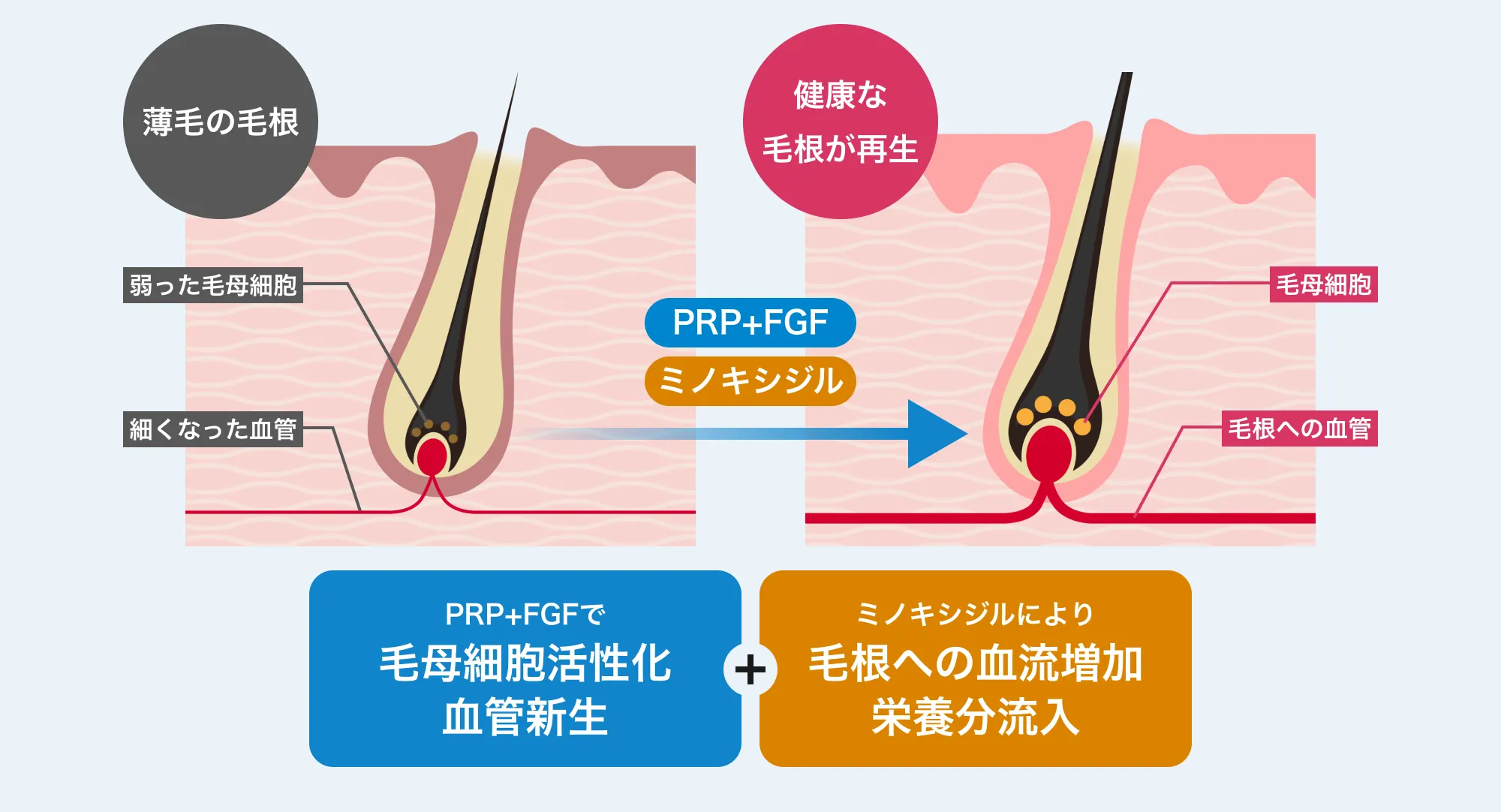 薄毛の毛根健康な毛根が再生